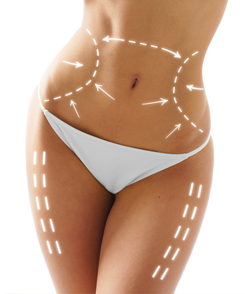 Lipoaspiração (lipoplastia)